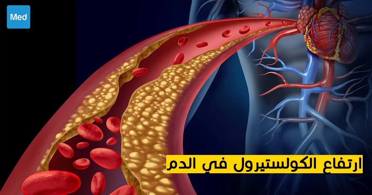 ارتفاع الكولستيرول في الدم